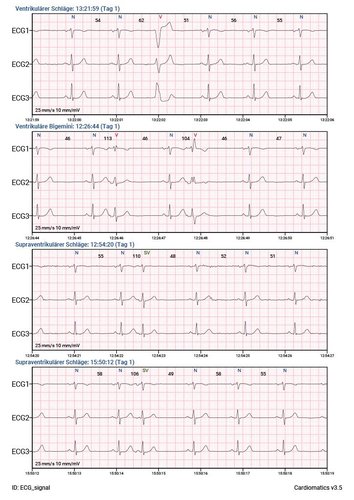 Cardiomatics Report Beispiel 5