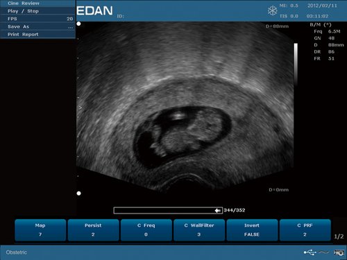 Transvaginalscan, Fetus Mask