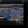 thumb: Ultraschall der Schilddrüse mit dem Acclarix AX2
