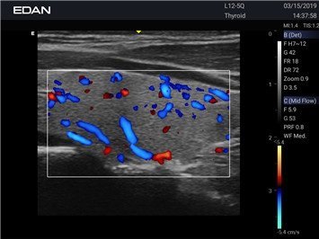 Ultraschall der Schilddrüse mit dem Acclarix AX2