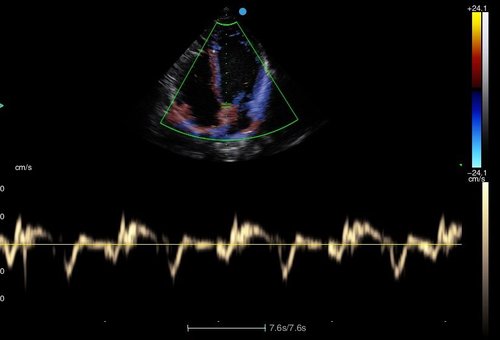 Herzscan mit dem Apogee 2300