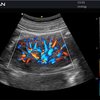 thumb: Ultraschall der Niere mit dem Acclarix LX3