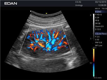Ultraschall der Niere mit dem Acclarix LX3