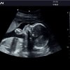 thumb: Schwangerschaftsultraschall mit dem Acclarix LX3