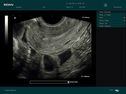 Uterus, sagittal