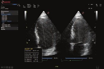 AutoEF - Automatische Messung der Ejektionsfraktion