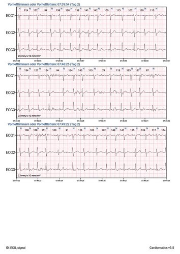 Cardiomatics Report Beispiel 11