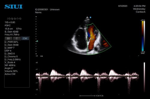 Herzscan mit dem Apogee 5300