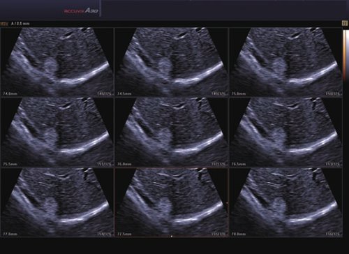 Leber Hemangioma mit 3D MSV