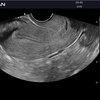 thumb: Ultraschalluntersuchung des Uterus mit dem Acclarix AX2
