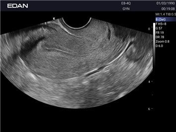Ultraschalluntersuchung des Uterus mit dem Acclarix AX2