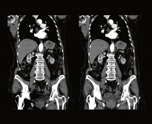 Abdominalscan mit dem Aquilion Lightning SP