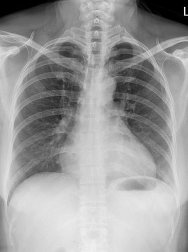 Röntgenaufnahme des Thorax mit dem Defender