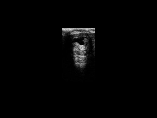 Ultraschalluntersuchung mit dem CTS-800