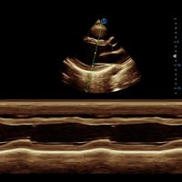 thumb: Ultraschalluntersuchung mit dem Apogee 6300