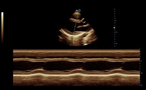 Ultraschalluntersuchung mit dem Apogee 6300