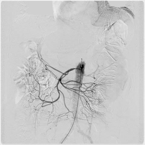 Angiographie mit dem Ultimax-i