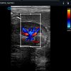 thumb: SIUI VP2 Ultraschallbild: Niere