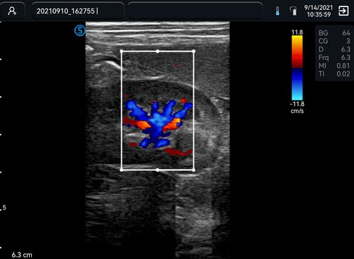 SIUI VP2 Ultraschallbild: Niere