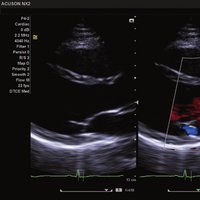 thumb: ACUSON NX2