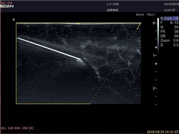 Ultraschall Nadelführung mit dem Acclarix LX9