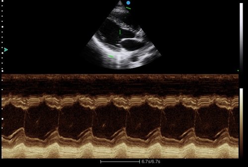Ultraschall Herz mit dem Apogee 2300