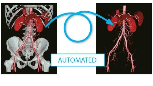 Anwendung der Knochensubstraktion mit dem Aquilion Lightning