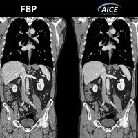 thumb: Bildgebung mit dem Aquilion One PRISM Edition