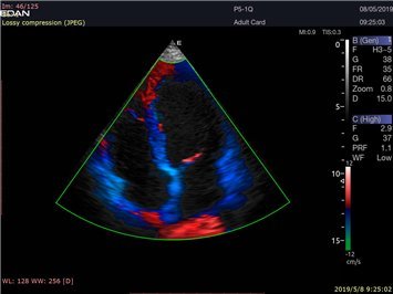 Herzultraschall mit dem Acclarix LX9 