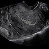 thumb: Ultraschall der Gebärmutter mit dem Apogee 6300