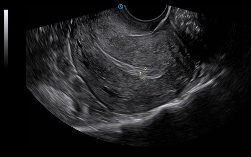 Ultraschall der Gebärmutter mit dem Apogee 6300