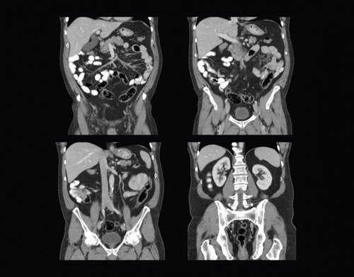 Abdominalscan mit niedrigem Kontrast mit dem Aquilion One GENESIS