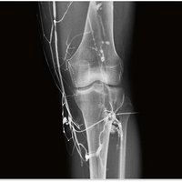 thumb: Venographie mit Xantara