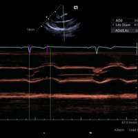 thumb: ACUSON Redwood