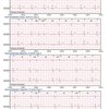 thumb: Cardiomatics Report Beispiel 6