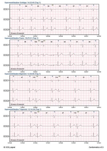 Cardiomatics Report Beispiel 6