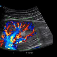 thumb: Farbdoppler Niere mit dem Apogee 2300