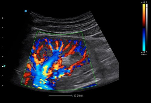 Farbdoppler Niere mit dem Apogee 2300