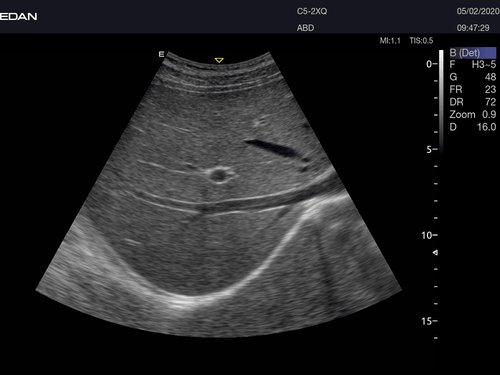 Abdominalscan mit dem Acclarix AX8 ohne eSRI