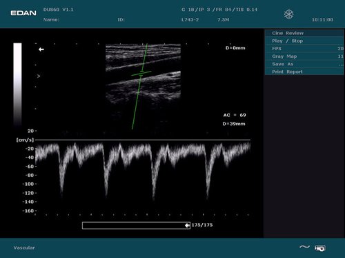 Karotide, doppler