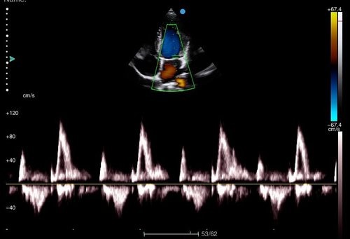 Herzscan mit dem Apogee 1000 Lite